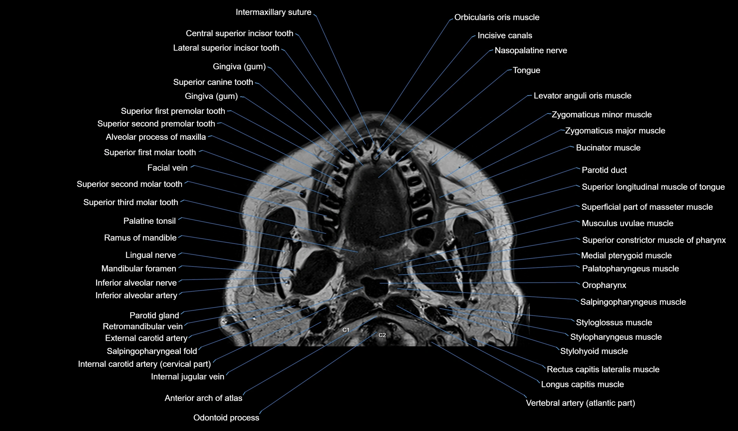 MRI face & paranasal sinuses(PNS) labelled  coronal  cross sectional anatomy 3T radiology  image-img-00001-00002.webp